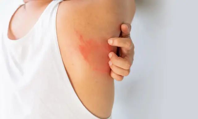 Un'eruzione cutanea rossa e pruriginosa sulla spalla, che fa sudare dietro la nuca per il disagio.