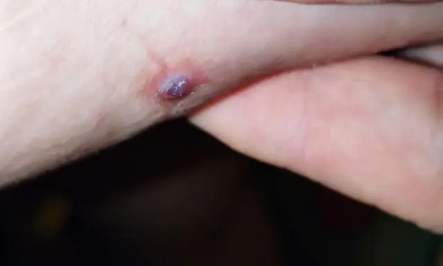 Una piccola piaga da decubito che sanguina, con un'area violacea al centro, su pelle chiara.