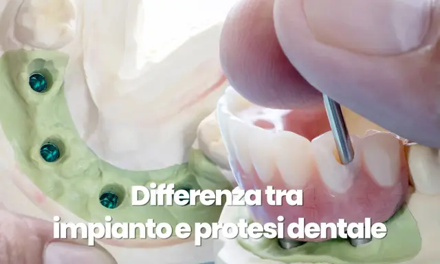 Modello dentale con impianti e protesi. L'igiene del cavo orale è fondamentale per la salute dei denti.