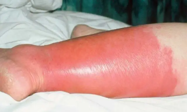 Gamba gonfia e arrossata, con segni di erisipela. La pelle appare lucida e tesa, con un'area di infiammazione estesa.