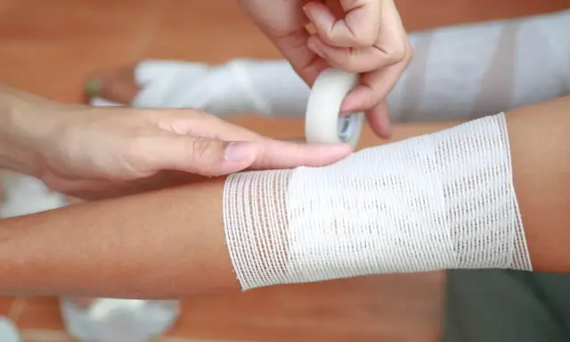 Applicazione di una fasciatura su un braccio, seguendo la regola del 9 ustioni per valutare l'estensione.