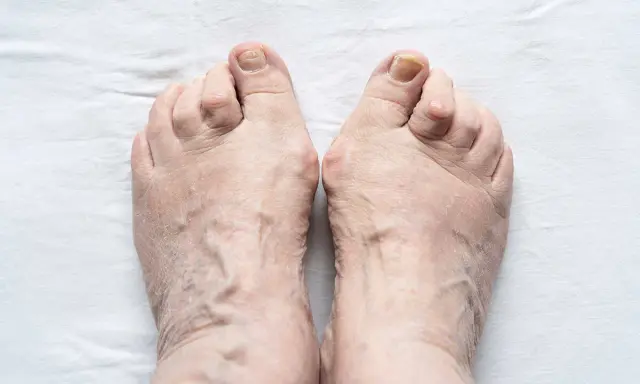 Piedi anziani con evidenti vene varicose e dita leggermente deformate, segno di piedi gonfi anziani.