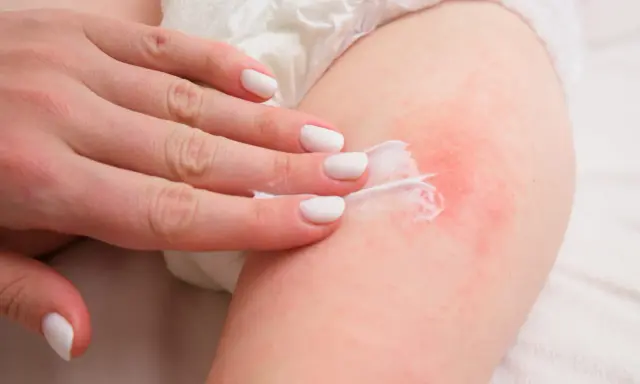 Mano applica crema su pelle arrossata, trattando una piaga da pannolino.