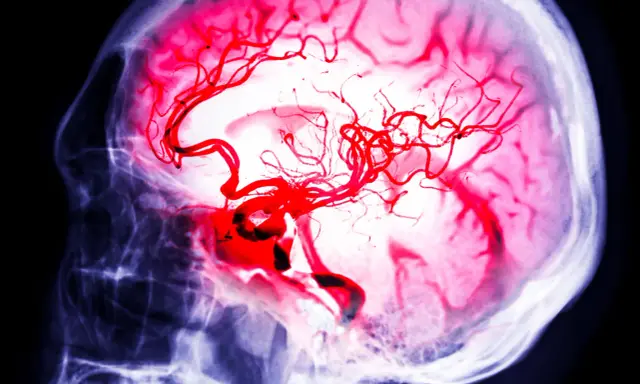 Immagine radiografica di un cervello con vasi sanguigni rossi evidenziati, che simboleggiano la lotta per l'aneurisma cerebrale sopravvivenza.