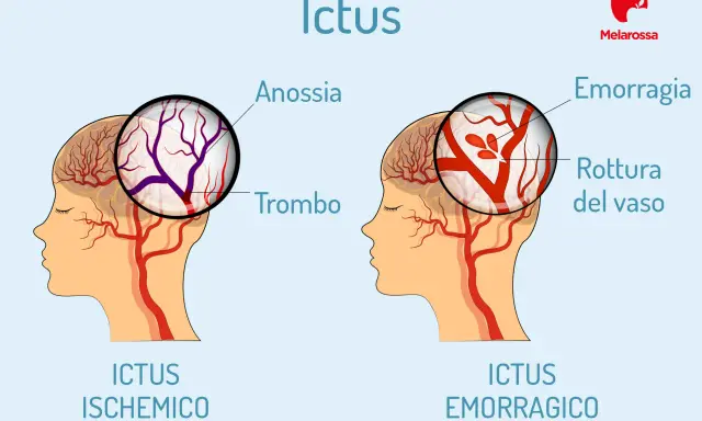 Ictus: confronto tra ischemico (trombo) ed emorragico (rottura vaso). L'emorragia cerebrale negli anziani è un rischio.