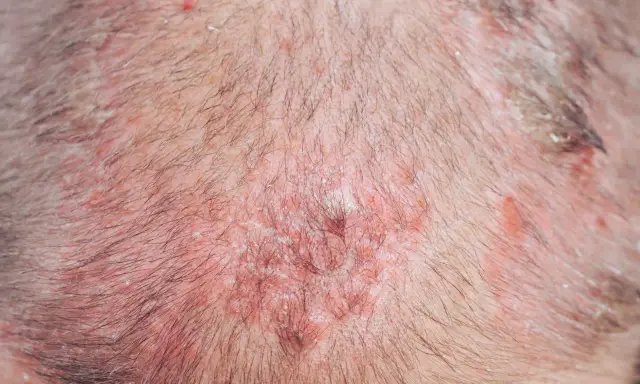 Primo piano del cuoio capelluto con arrossamenti e croste, tipici di condizioni cutanee che possono colpire gli anziani.