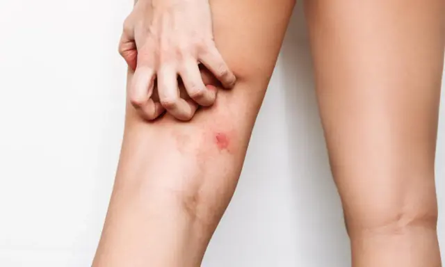 Mano che si gratta l'interno coscia con arrossamento. Possibili rimedi per l'irritazione interno coscia.