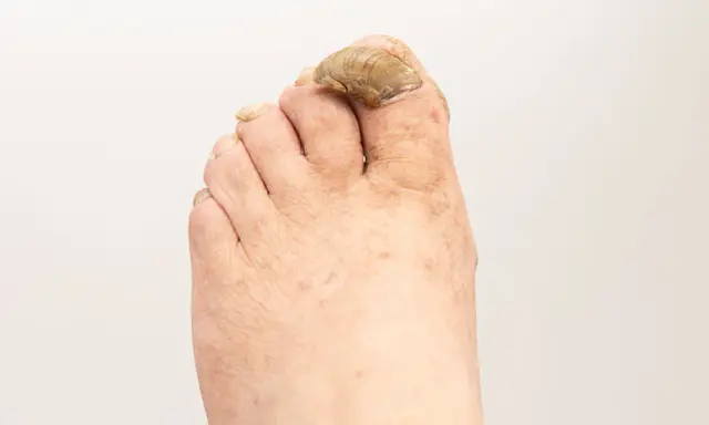 Primo piano di un piede con unghie dei piedi ispessite e scolorite, che suggerisce la necessità di rimedi per le unghie dei piedi ispessite.