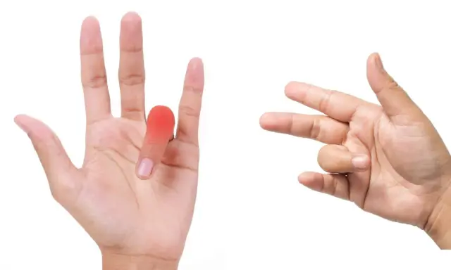 Mano con dito arrossato e un'altra mano che mostra movimenti per esercizi utili per dito a scatto.