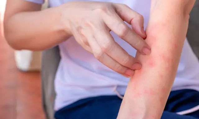 Braccio con pelle arrossata e puntini rossi, che indica la necessità di rimedi per l'irritazione cutanea.