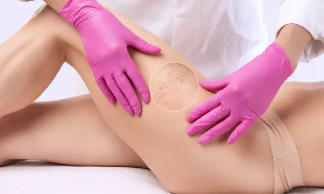 Mani con guanti rosa esaminano la gamba, evidenziando le teleangectasie, una delle conseguenze della cattiva circolazione sanguigna.