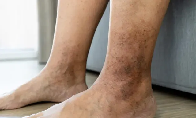 Gambe e caviglie con macchie scure e arrossamenti, indicative di dermatite da stasi.