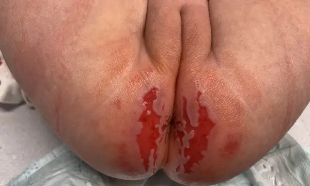 Pelle arrossata e irritata, con aree umide e lucide, tipica dell'orticaria da pannolino.