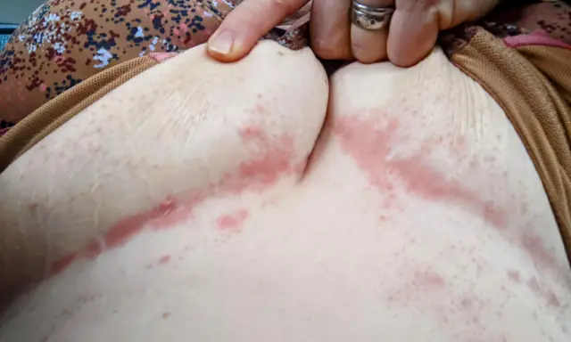 Pelle arrossata e irritata sotto il seno, con segni di piaghe da decubito. Una mano indica l'area interessata.