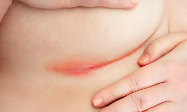 Arrossamento e irritazione cutanea sotto il seno, sintomo di dermatite da sudore. Mani che accarezzano delicatamente la zona interessata.