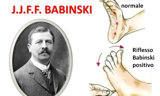 Ritratto di J.J.F. Babinski, con illustrazioni del riflesso normale e del riflesso di Babinski positivo.