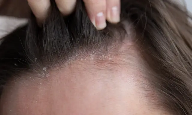 Dettaglio del cuoio capelluto con squame biancastre e arrossamento, indicativo di dermatite atopica.