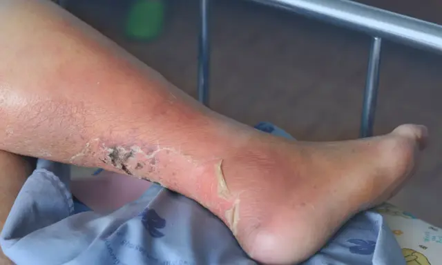 Gamba con arrossamento, desquamazione e lesioni cutanee, possibili sintomi di ulcera alle gambe.