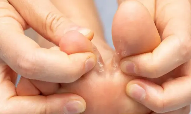 Dita dei piedi con pelle secca e screpolata tra le dita. Un podologo cosa fa? Aiuta a trattare queste condizioni.
