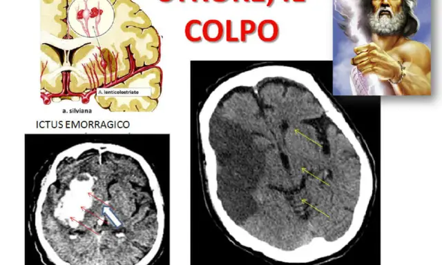 Immagini mediche mostrano ictus cerebrali, emorragici e ischemici. La vasculopatia cerebrale cronica può influenzare l'aspettativa di vita.
