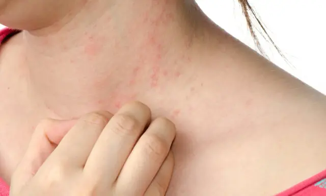 Pelle arrossata e irritata sul collo, con piccole pustole rosse. Una mano si gratta, sintomo di sudore e prurito.