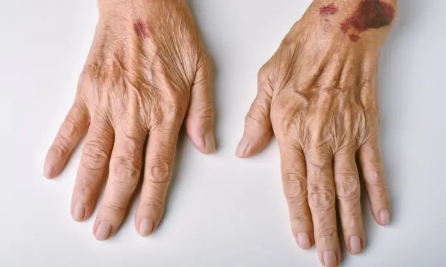 Mani anziane con macchie di sangue sulla pelle, segni di fragilità e fragilità cutanea.