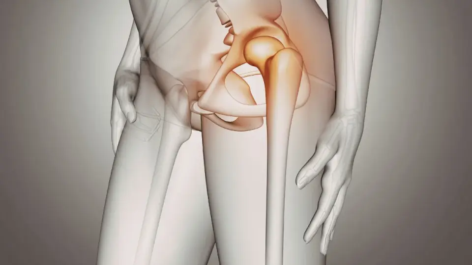 Illustrazione anatomica che evidenzia la borsite all'anca, con l'area infiammata in arancione.