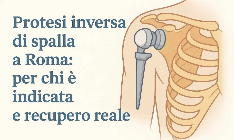 Illustrazione di una protesi inversa spalla, con testo che ne spiega indicazioni e recupero.