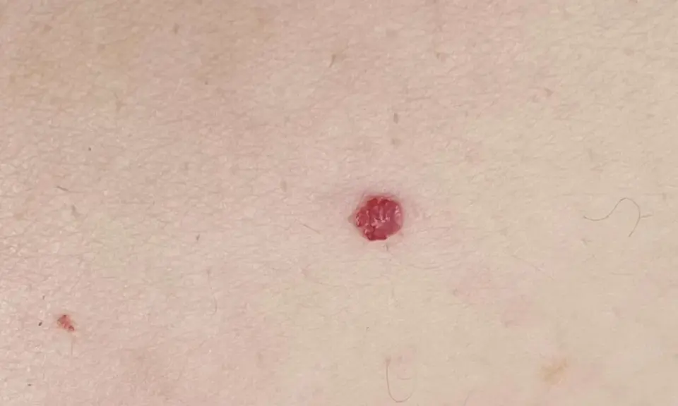 Una piccola macchia rossa sulla pelle, di forma quasi circolare, spicca sulla cute chiara.