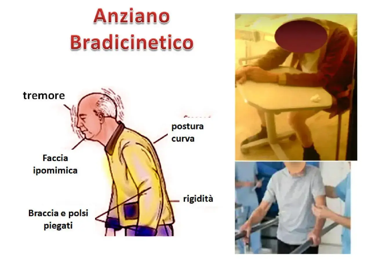 Anziani con difficoltà a parlare, tremore, postura curva e rigidità. Illustrazione e foto di persone anziane con sintomi di bradicinesia.