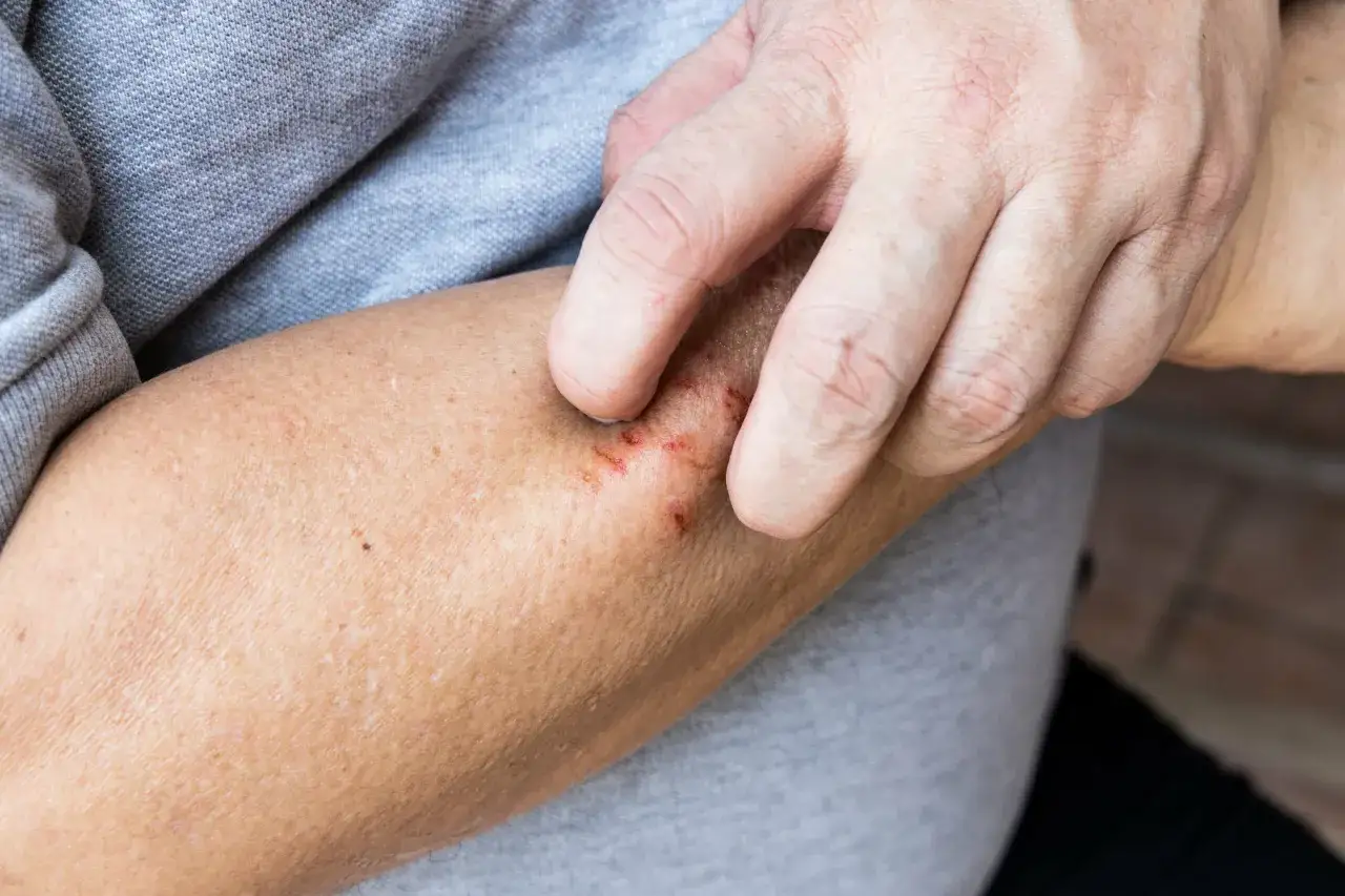 Dita che si grattano un braccio con lesioni cutanee, possibili cause del prurito.
