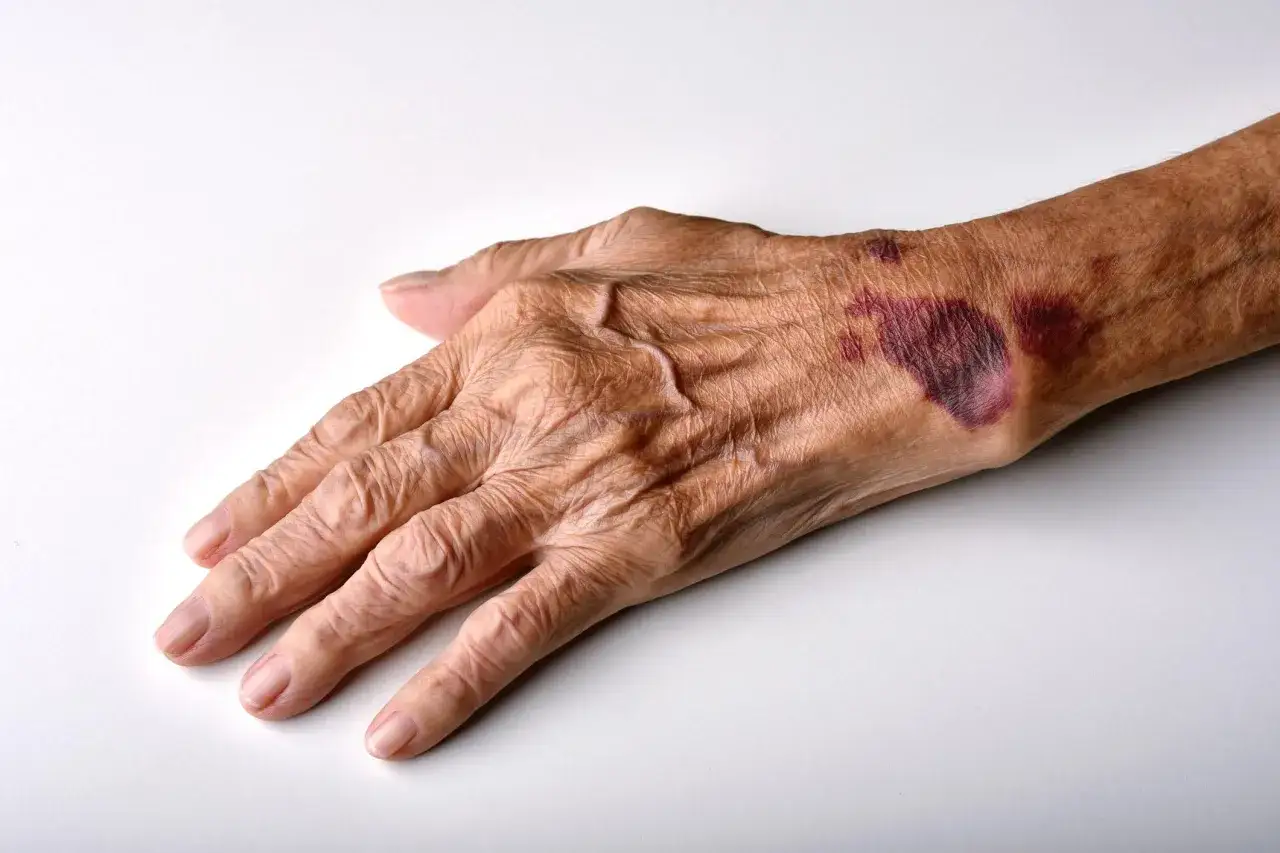 Mano anziana con ecchimosi evidenti, pelle assottigliata da cortisone. Rimedi naturali per la fragilità cutanea.