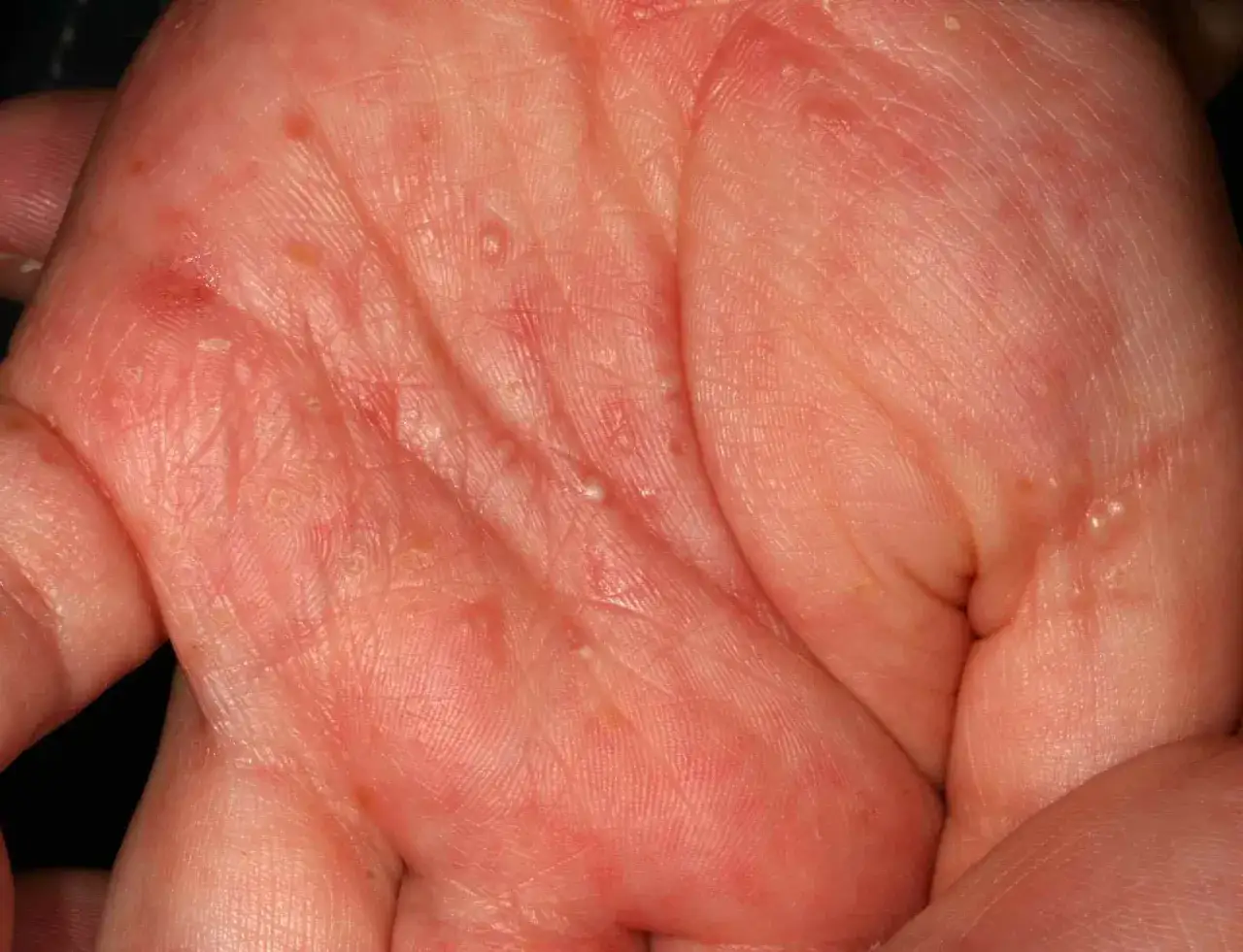 Mano con eritema e vescicole, sintomi di scabbia. Si cercano scabbia rimedi della nonna per alleviare il prurito.