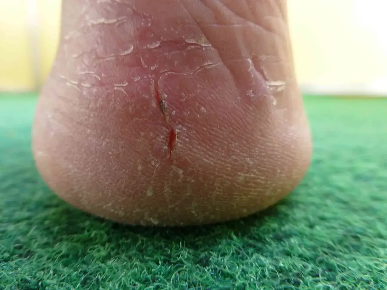 Piede con pelle secca e screpolata, una piccola ferita sul tallone. È ora di pensare a chi cura i piedi per un sollievo immediato.