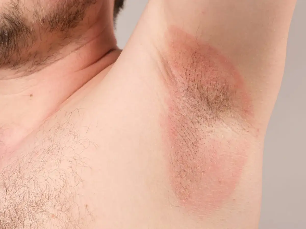 Arrossamento sotto le ascelle, un'irritazione cutanea visibile che potrebbe causare disagio.