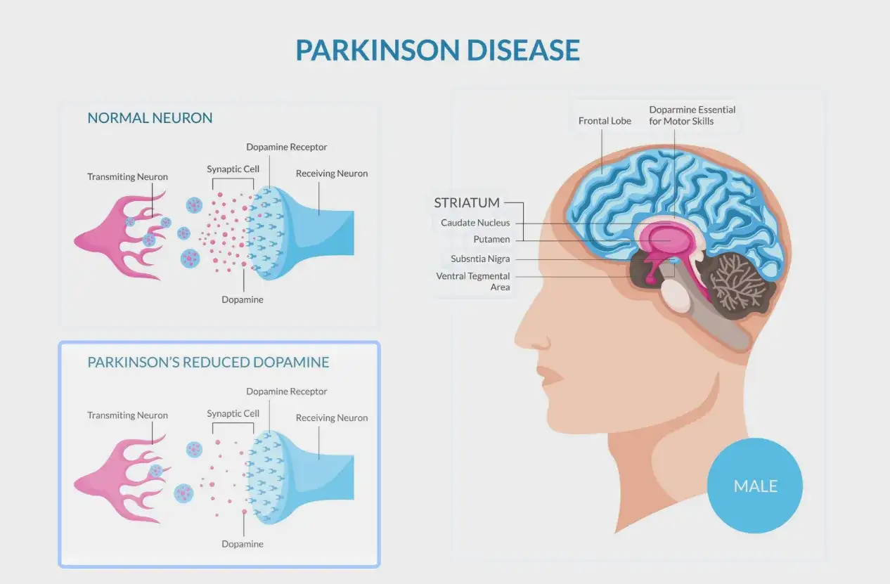 Il cervello umano mostra la dopamina essenziale per le abilità motorie. Confronto tra neuroni normali e quelli con ridotta dopamina, illustrando i 10 sintomi del Parkinson.