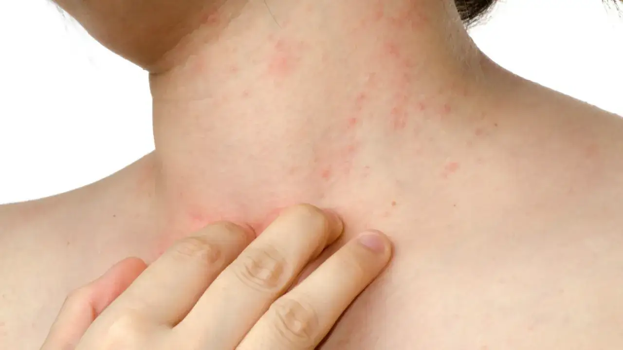 Dito, un dito gratta un collo arrossato e irritato, segno di un fastidioso prurito al collo.