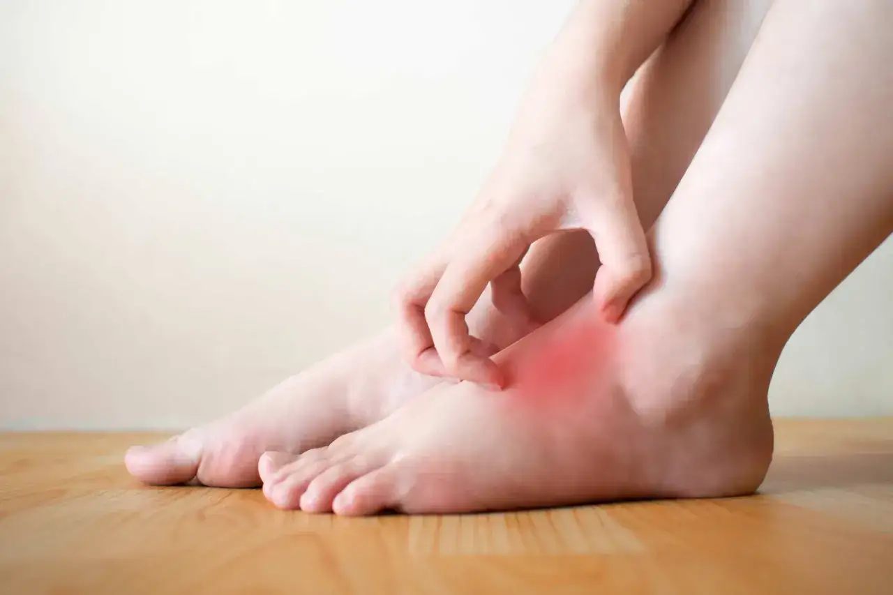 Piede con arrossamento e prurito, possibile eczema diabetico.