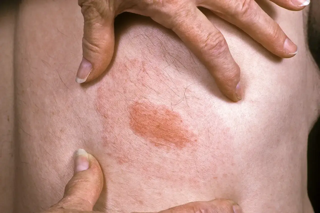Dita indica un'area arrossata sulla pelle, suggerendo un possibile dolore alla pelle al tatto.
