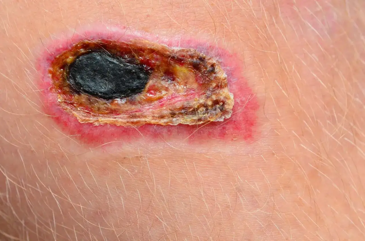 Piaga da decubito nera, con bordi arrossati e tessuto necrotico. La cura è fondamentale per evitare complicazioni.