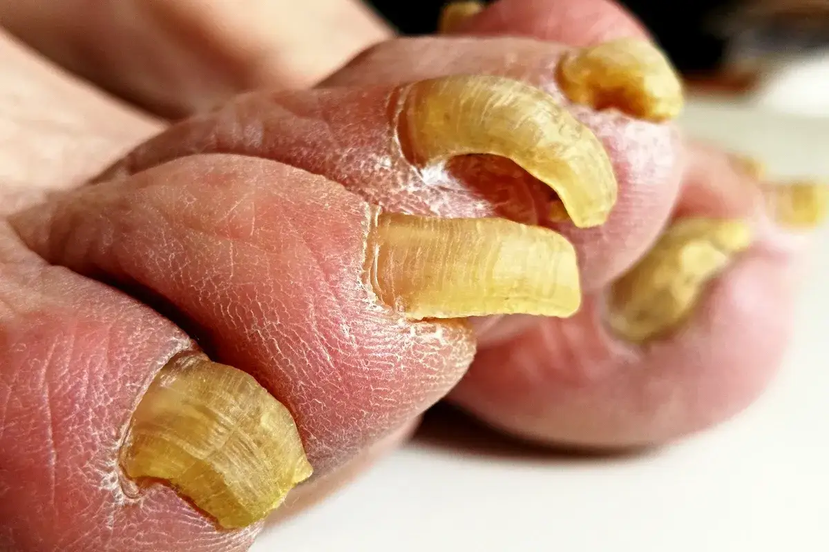 Dita del piede con pelle secca e unghia a uncino, ingiallite e ispessite, che crescono in modo innaturale.