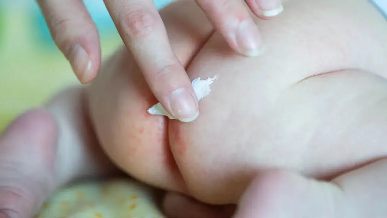 Dito, un dito applica crema su un'area arrossata, segno di ustione da pannolino.