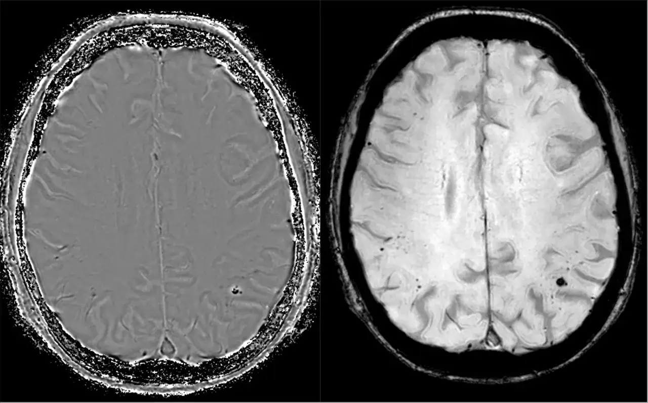 Risonanza magnetica cerebrale mostra segni di vasculopatia cerebrale cronica nell'anziano, con piccole lesioni vascolari visibili.