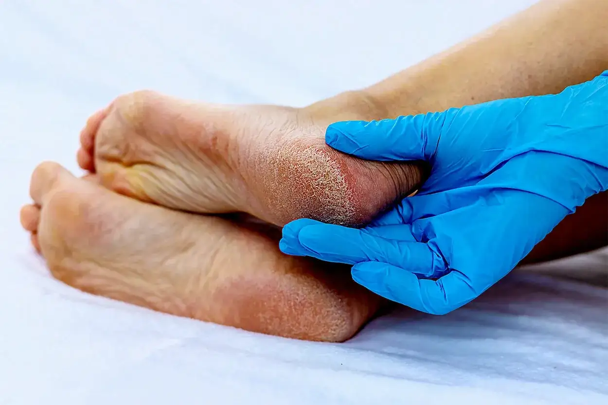 Mano con guanto blu esamina tallone screpolato. La podologia cos'è? Cura dei piedi per salute e benessere.