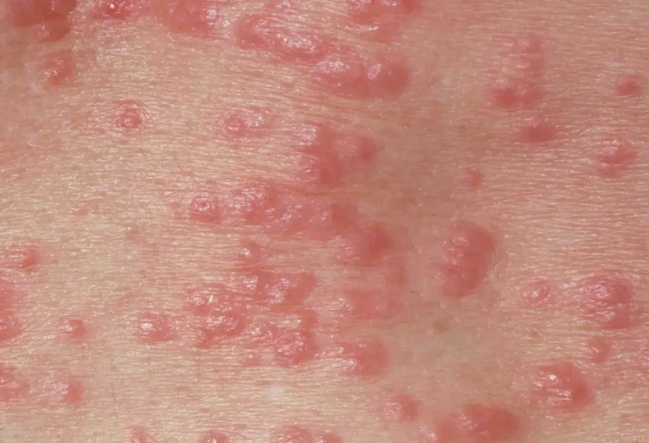 Ingrandimento della pelle con numerose papule rosa e arrossate, indicative di irritazioni cutanee.
