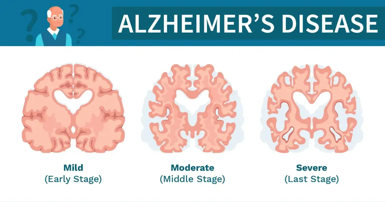 Il cervello mostra la progressione dell'alzheimer in quanto tempo degenera: da lieve a moderato, fino a grave.
