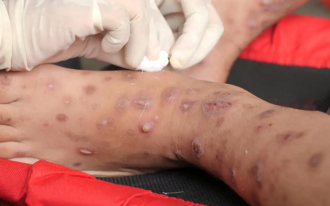 Mani guantate applicano un trattamento su una gamba affetta da scabbia, dove la candeggina uccide gli acari.