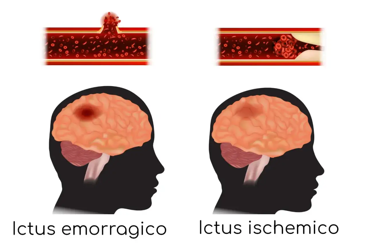 Ictus emorragico e ischemico: il primo causa un sanguinamento nel cervello, il secondo un blocco che può portare a perdita di memoria improvvisa.
