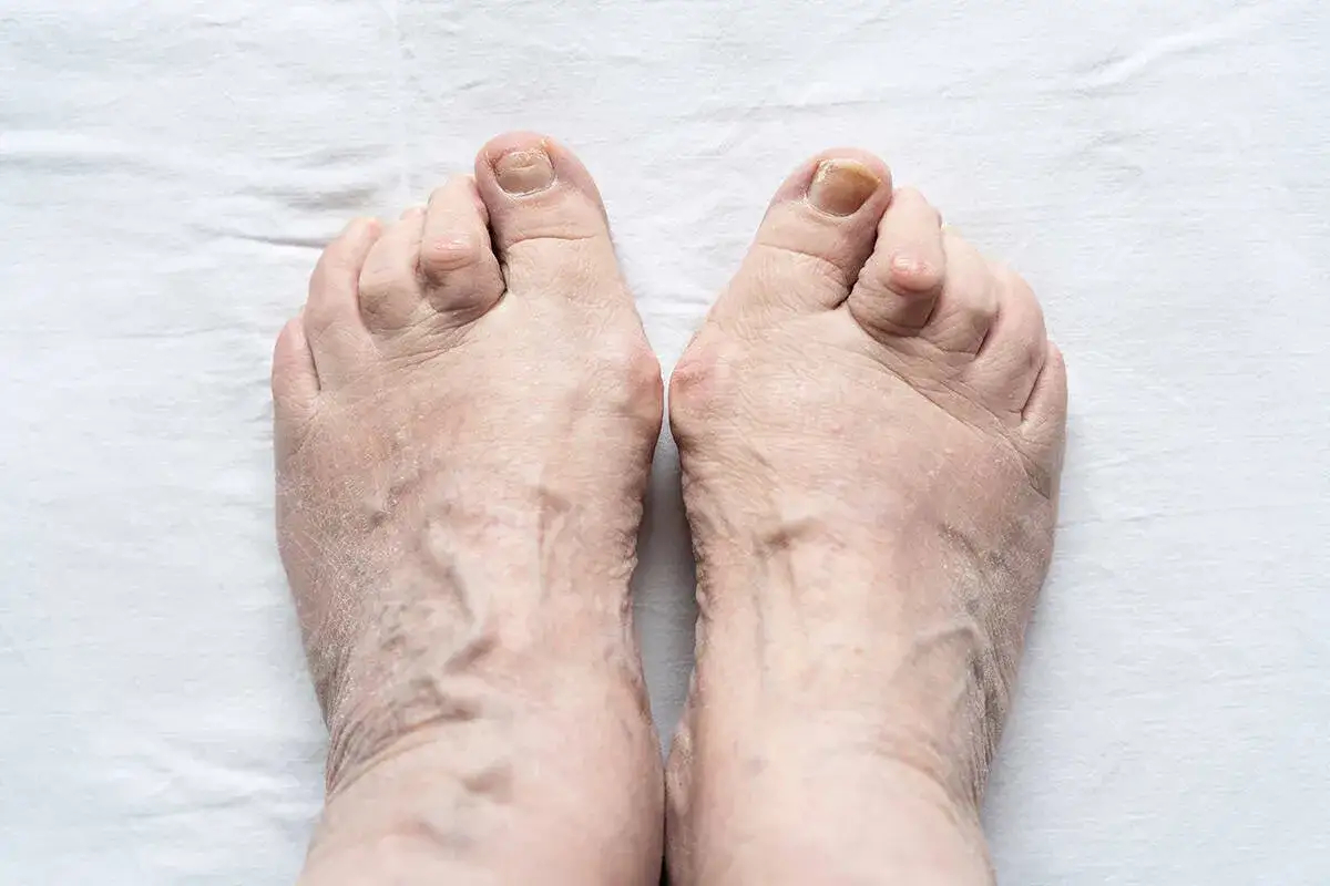 Piedi gonfi anziani con vene evidenti e dita deformate.