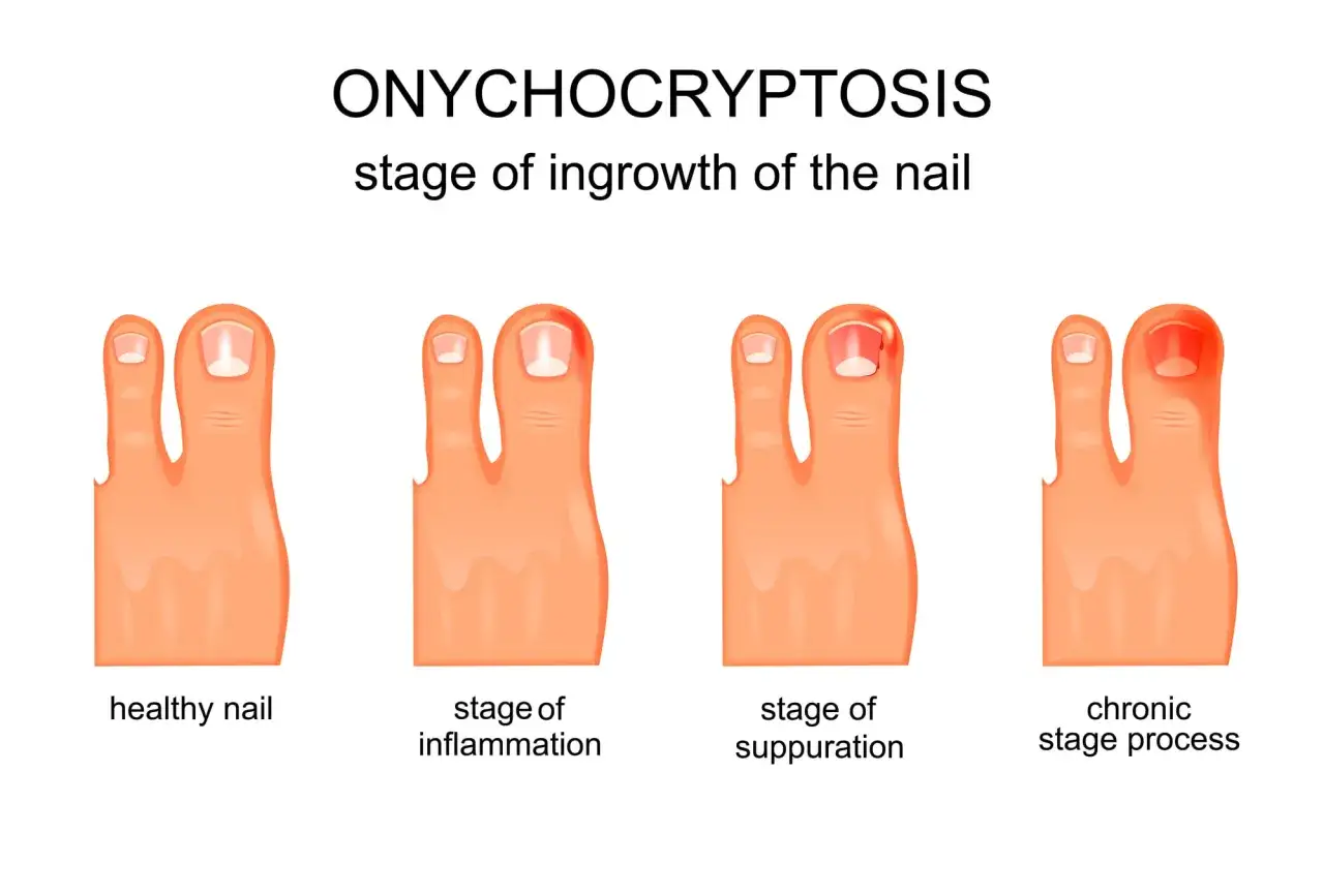 Illustrazione delle fasi dell'onicocriptosi: da unghie piedi curve e sane a infiammazione, suppurazione e processo cronico.